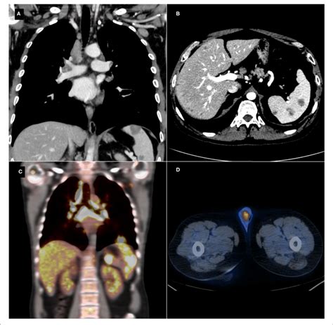 Thoraco Abdominal Contrast Enhanced Computed Tomography Ct Scan