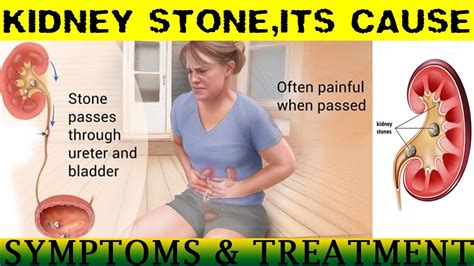 Kidney Stone Causesymptomsprevention Youtube