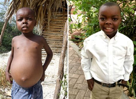 Kwashiorkor Malnutrition Archives Love A Child
