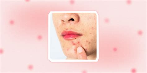 How To Get Rid Of Pimples On Lips According To Board Certified