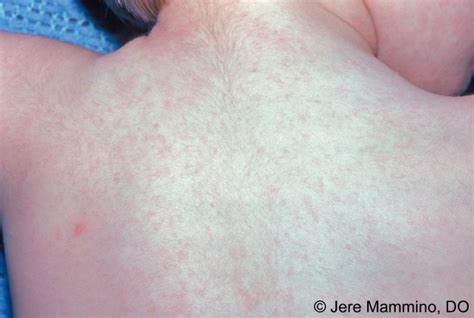 Roseola Infantum American Osteopathic College Of Dermatology Aocd