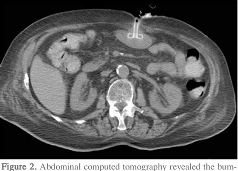 Figure 2 From The Advantage Of Retrieval Peg Tubes In Patients With