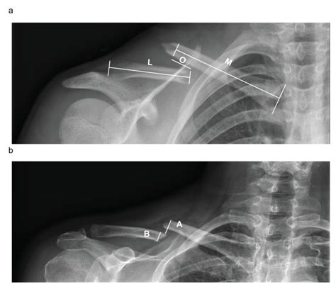 Diagnostics Free Full Text Midshaft Clavicle Fractures Treated