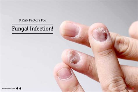 8 Risk Factors For Fungal Infection By Dr Hetal Jobanputra Lybrate