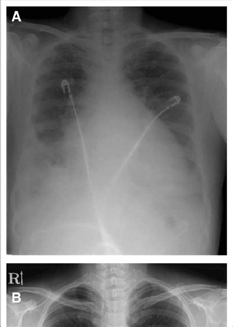 A Initial Chest X Ray Chest Pa B Chest X Ray At 2 Y Downloaded