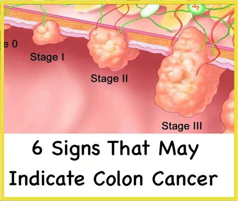 What Stage Of Colon Cancer Symptoms What Are The Four Stages Of