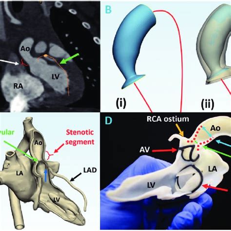 The 2 Different Techniques In Supravalvular Aortic Stenosis Repair Download Scientific Diagram