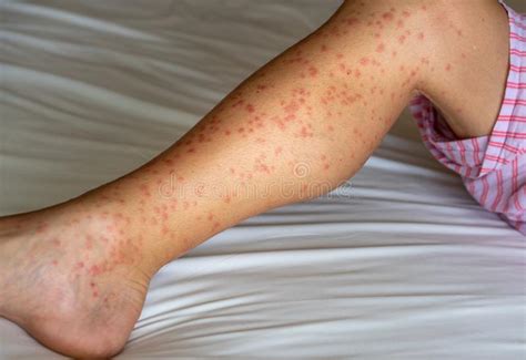 Papular Hives After Mosquitos Bite Stock Photo Image Of Allergic