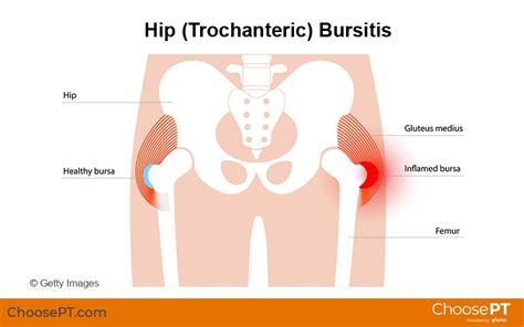 Guide Physical Therapy Guide To Hip Bursitis
