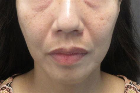 Melasma Hyperpigmentation Removal Brisbane Skin Dermatologists