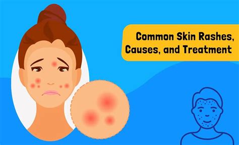 20 Common Skin Rashes Causes And Treatment Resurchify
