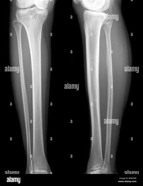 Normal Lower Legs X Ray Stock Photo Alamy
