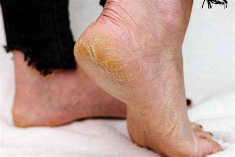 How To Remove Dry Skin On Feet Doncaster Foot Clinic