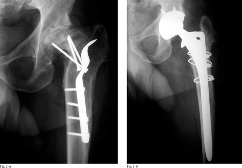Figure 2 From Extended Trochanteric Osteotomy In Complex Primary Total