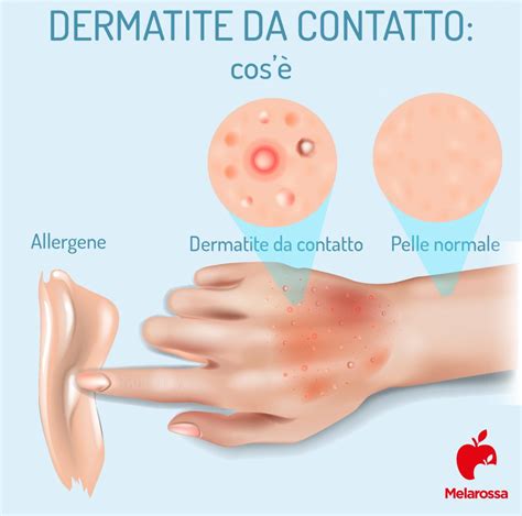 Dermatite Allergica Cause Sintomi E Rimedi Uwell Hot Sex Picture