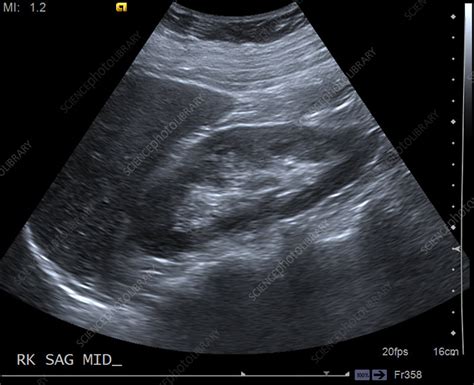 Normal Kidney Size Ultrasound