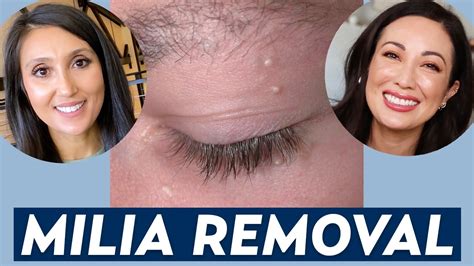 How Do You Remove Milia A Dermatologist Shares Milia Treatment