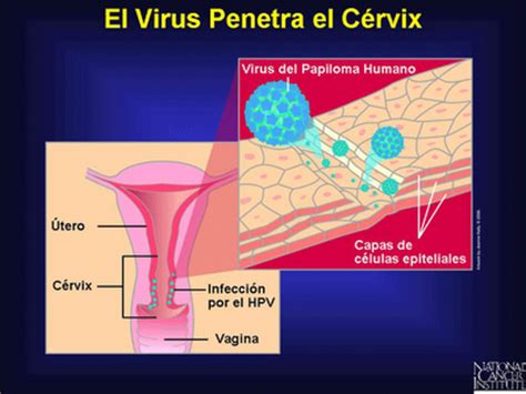 Virus Del Papiloma Humano VPH Imagenes Del Virus Del Papiloma Humano