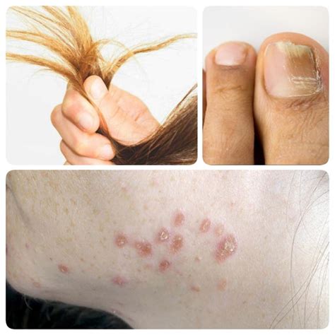 Hair loss can be down to a number of different variables that can lead to either the most severe form of hair loss or a slight amount of thinning. Protein Deficiency - All About Proteins