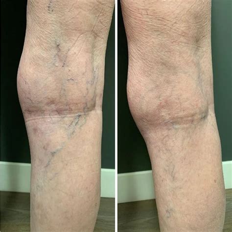Before And After Vein Photos Of Varicose And Spider Veins Ithriveveins