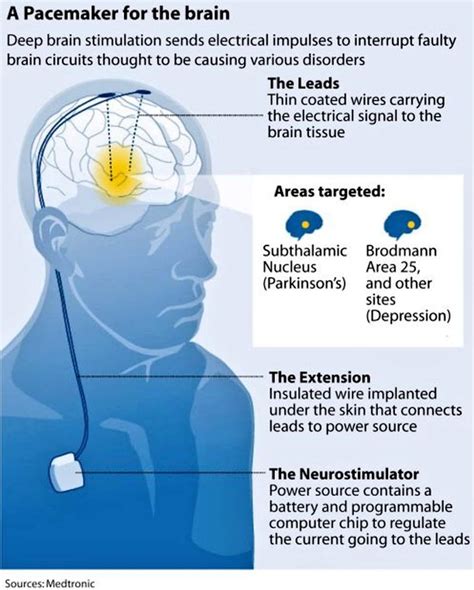 Deep Brain Stimulation Provides Antidepressant Effects For Treatment