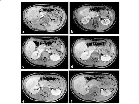 Focal Nodular Hyperplasia In A 14 Year Old Female Patient The Hepatic