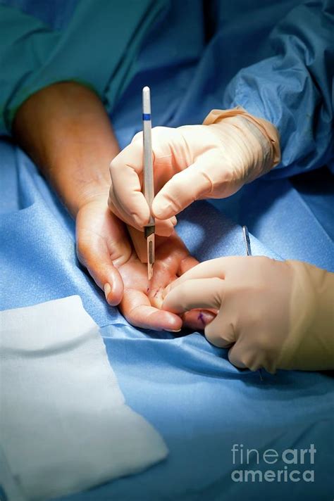 Ganglion Removal Surgery Photograph By Jim Varney Science Photo Library Pixels