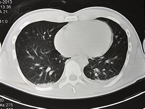 Medicare To Cover Lung Cancer Screening With Ct Scan News Uab