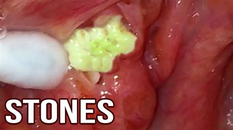 Compilation Of My Extreme Tonsil Stones 2018 Youtube