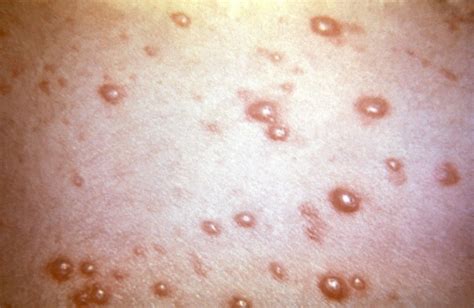 Shingles A More Painful Version Of Chickenpox Vaccine Recommended For