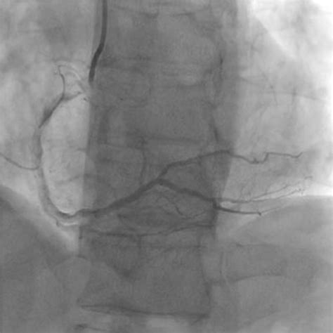 Post Procedure Severely Calcified Right Coronary Artery Csi360