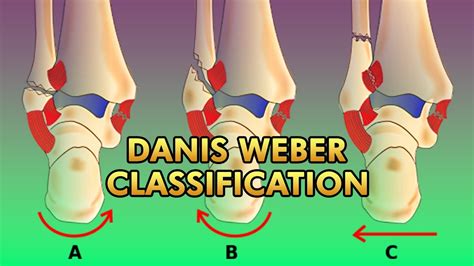Danis Weber Classification Of Malleolar Fractures Of The Ankle Youtube