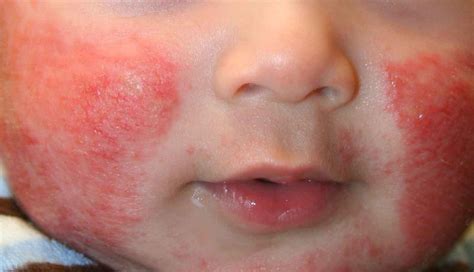 Causes Of Skin Rashes