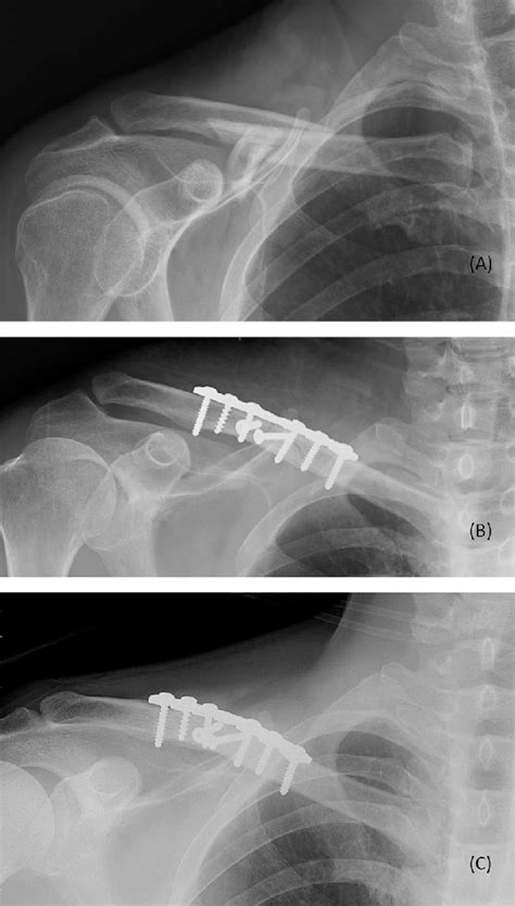 A A Right Clavicle Comminuted Fracture With Marked Shortening Ota