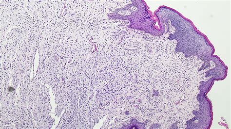 Pathology Outlines Fibroepithelial Stromal Polyp
