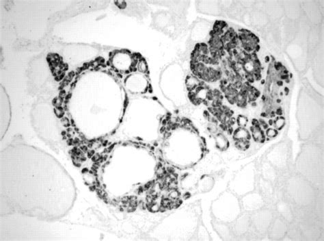 C Cell Hyperplasia And Medullary Thyroid Carcinoma Clinicopathological