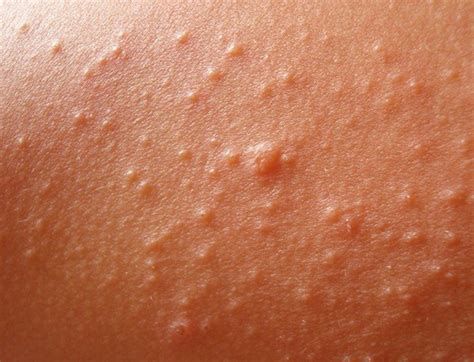 Eft For Infectious Mono Rash And Hives