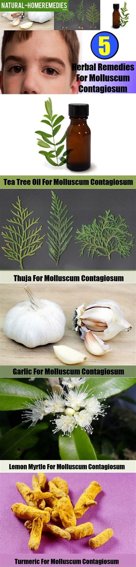 5 Best Herbal Remedies For Molluscum Contagiosum Natural Home