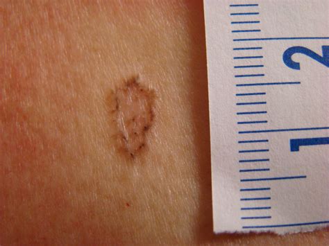 40 Basal Cell Carcinoma On Chest Pictures Images