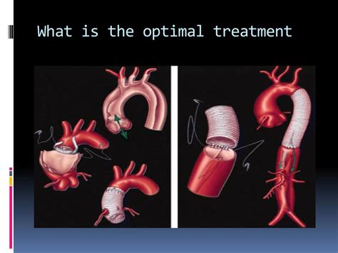 Ppt Management Of Acute Aortic Dissection Type A Powerpoint