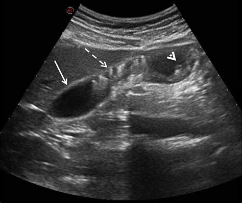 Adenomyomatosis Of The Gallbladder As A Cause Of Recurrent Abdominal