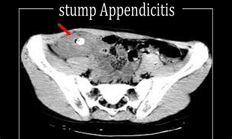 Case Of Stump Appendicitis Two Years After First Laparoscopic