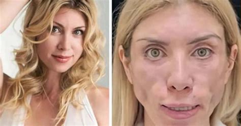 Yulia Tarasevich Botched Plastic Surgery Left Russian Beauty Queen Unable To Close Eyes Meaww