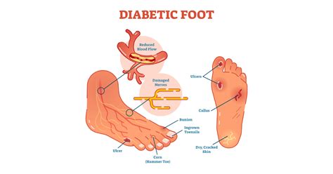 Diabetic Foot Symptoms Causes Prevention And Treatments