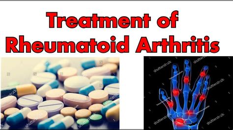 Treatment Of Rheumatoid Arthritis American College Of Rheumatology
