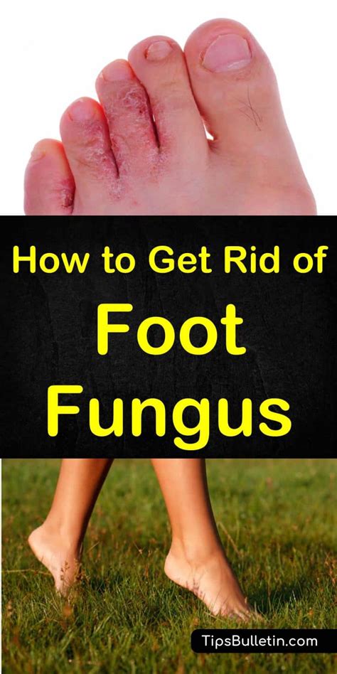 How To Get Rid Of Foot Fungus Home Remedies Treatments Foot
