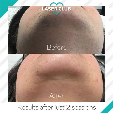 Pcos Hair Growth How Can Laser Hair Removal Help • Laser Club