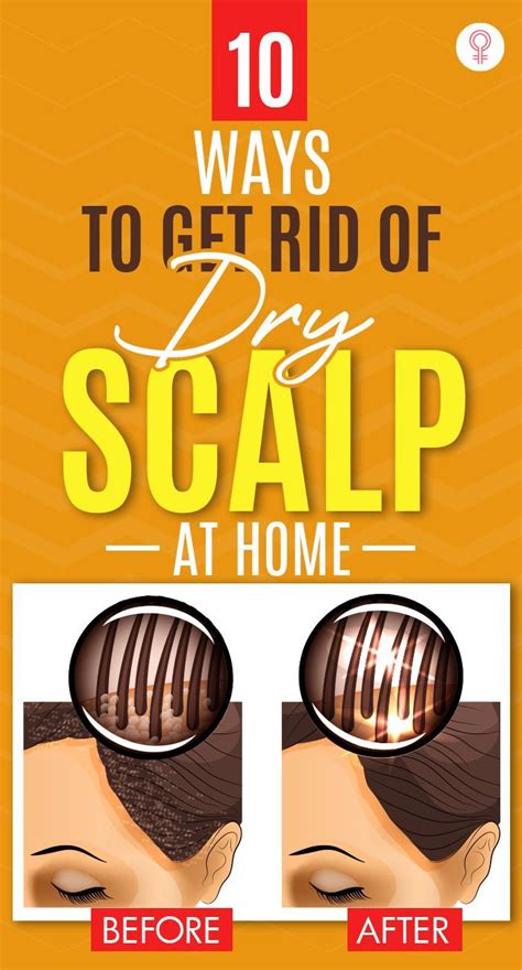 10 Best Home Remedies For Dry Scalp And Prevention Tips Artofit