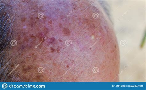 Bald Head Old Man Stock Photo Image Of Freckles Aged 142015630