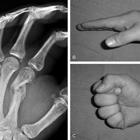 Ac A An Xray Shows A Displaced Transverse Fracture Of The Fourth